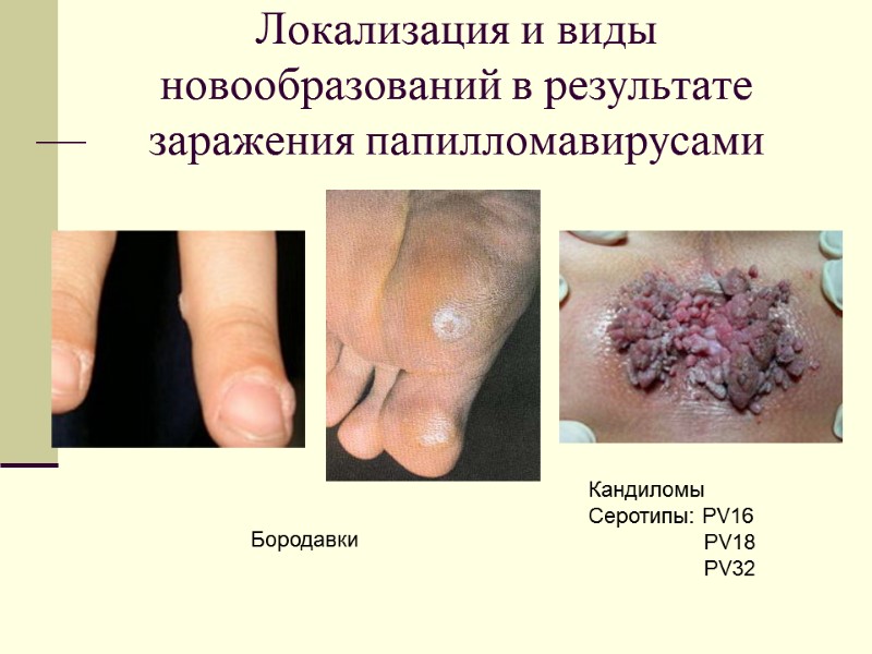 Локализация и виды новообразований в результате заражения папилломавирусами Кандиломы Серотипы: PV16   